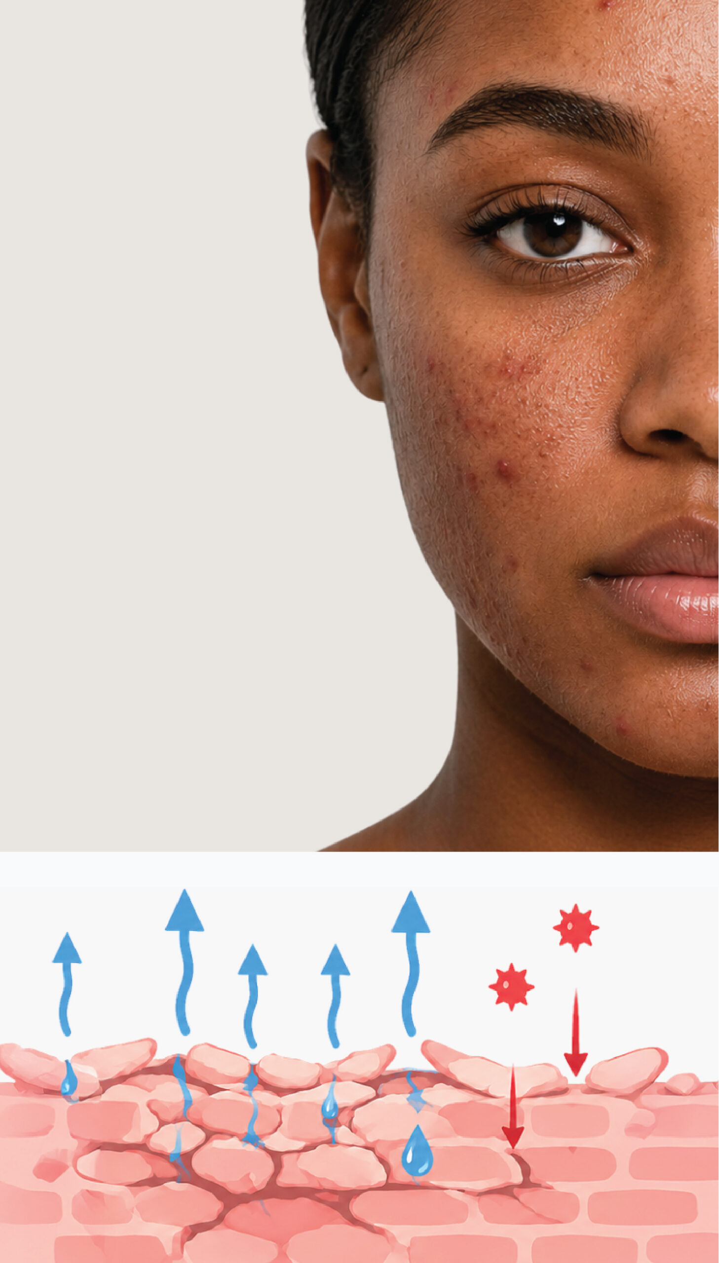 Illustration showing a compromised skin barrier