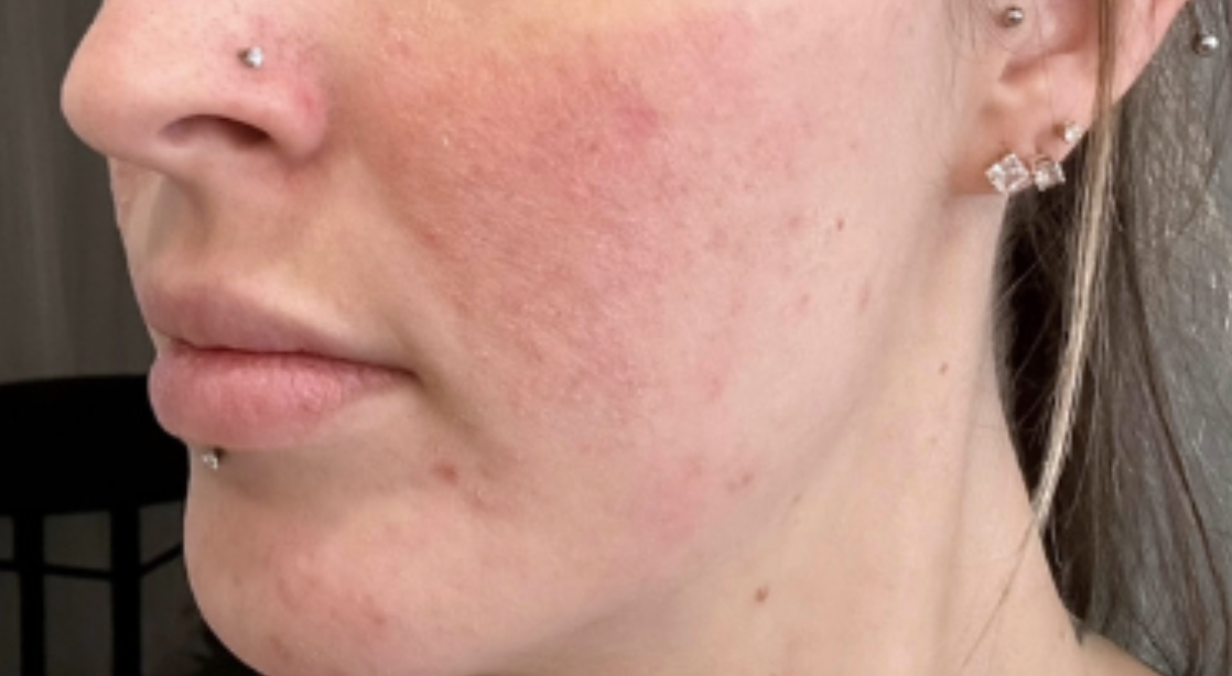 Skin after Hale Derma use