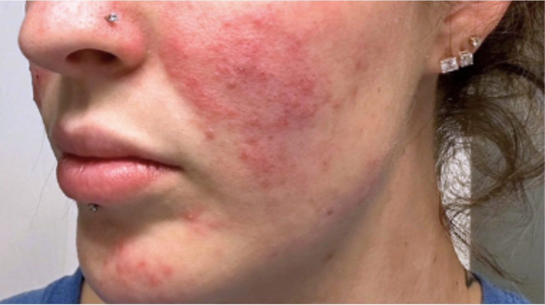 Skin before Hale Derma use