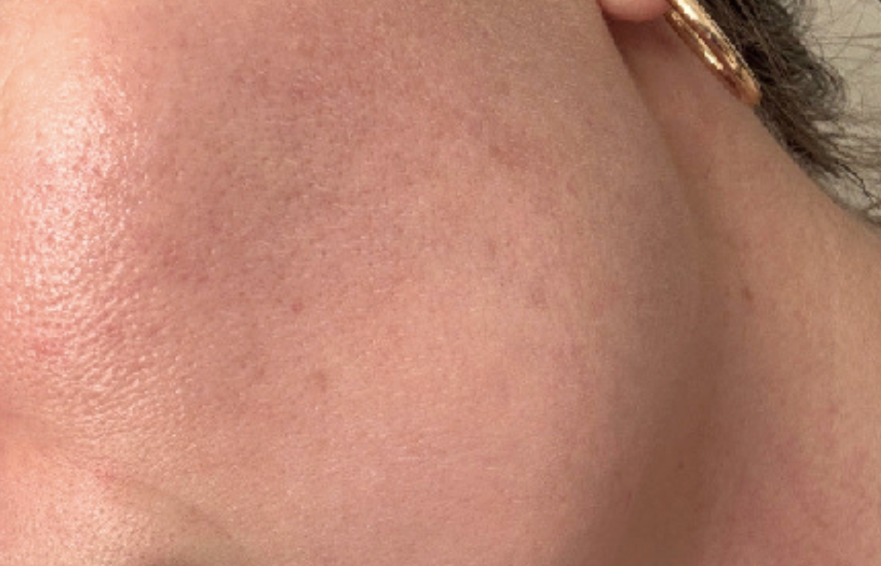 Skin after Hale Derma use