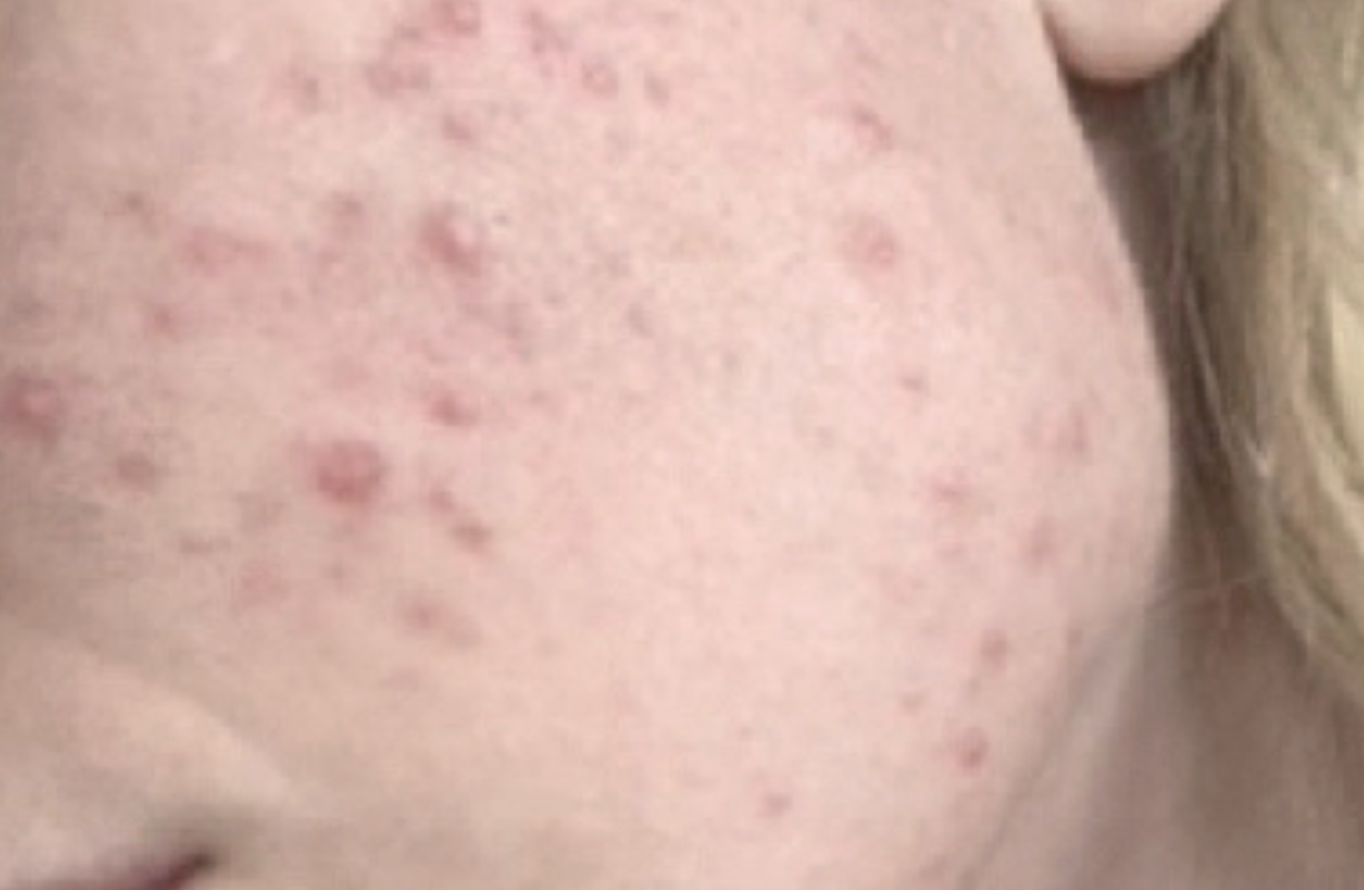 Skin before Hale Derma use