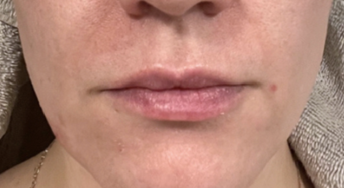 Skin after Hale Derma use