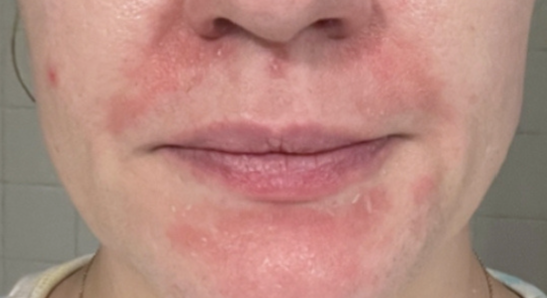 Skin before Hale Derma use