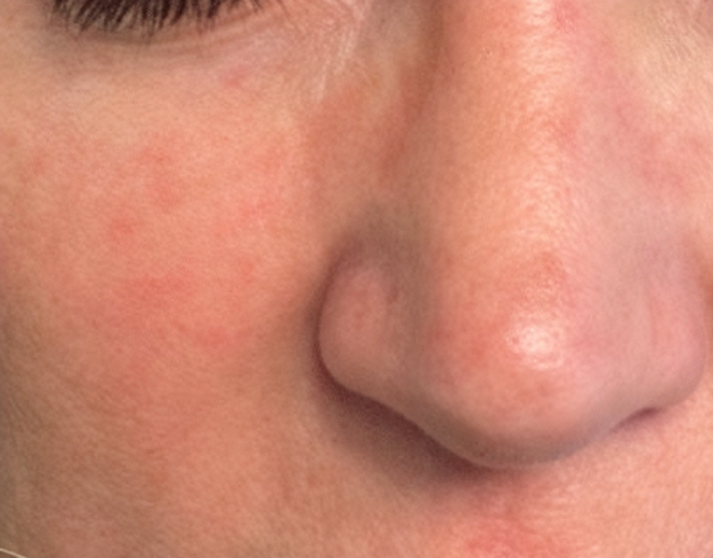Skin after Hale Derma use — Set 06