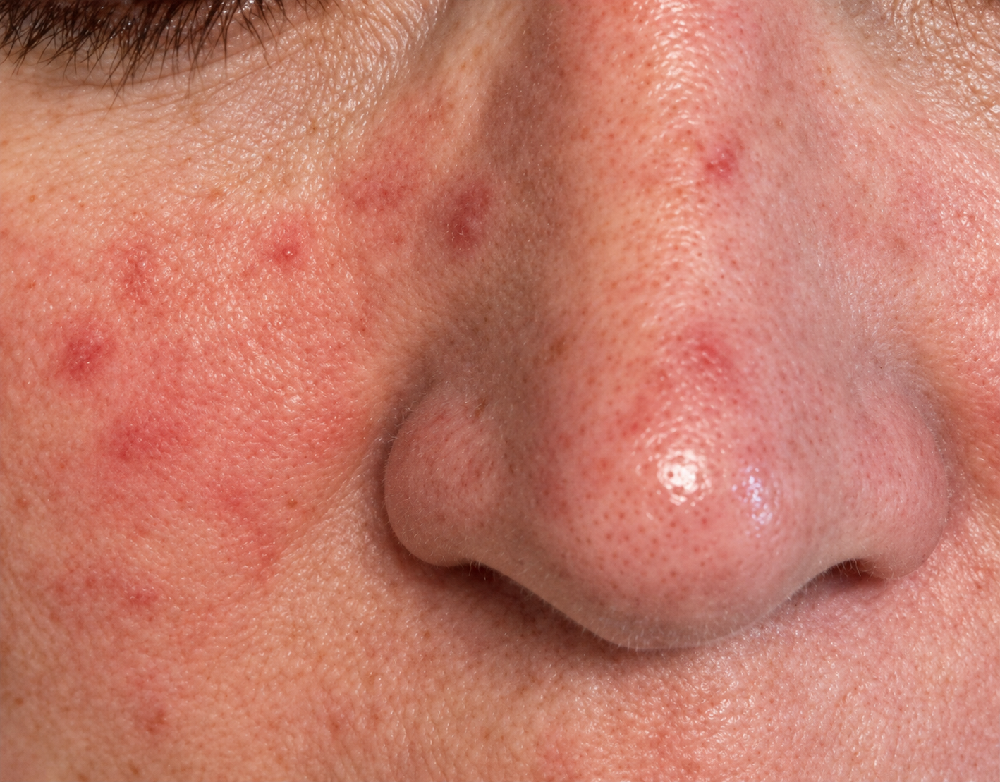 Skin before Hale Derma use — Set 06